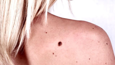 Recognizing Abnormal Moles in Humble TX
