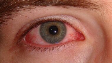 Pink Eye Symptoms and Treatment