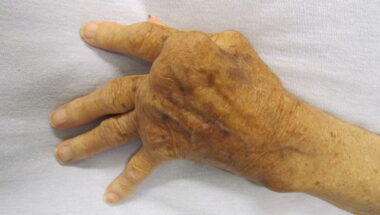 Signs and Symptoms of Rheumatoid Arthritis in Humble TX