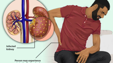 Signs of a Kidney Infection