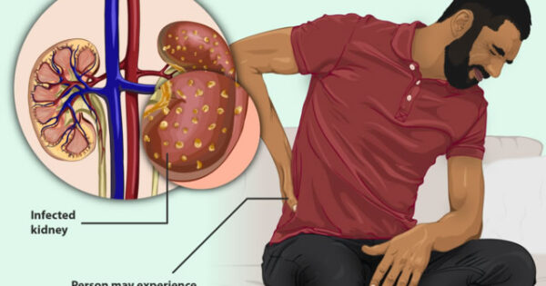 Signs of a Kidney Infection | Wellspire Medical Group