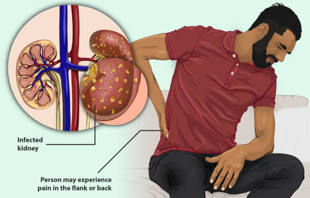 symptoms of a kidney infection