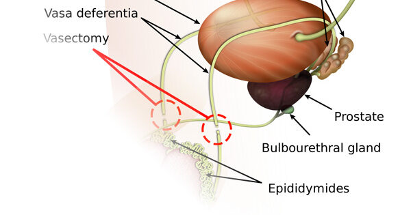 10-facts-about-getting-a-vasectomy-wellspire-medical-group