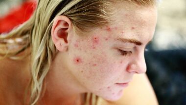 Adult Acne in Humble TX