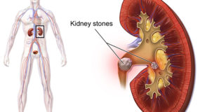 Kidney Stone Treatment in Humble TX