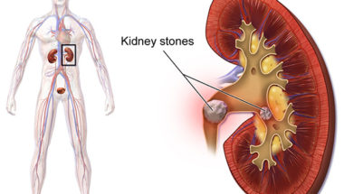 Kidney Stone Treatment in Humble TX