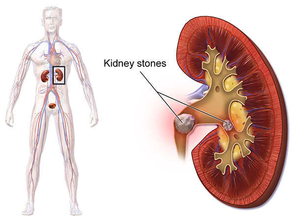 Kidney Stone Treatment in Humble TX