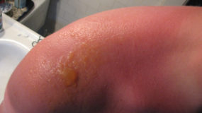 4 Signs Of A Sunburn