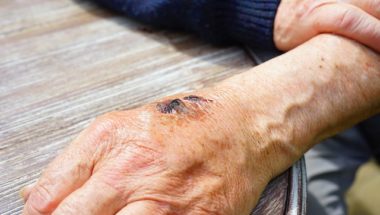 Signs Your Wound May Be Infected