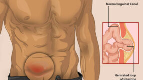Hernia Treatment in Humble TX