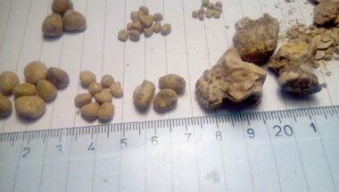 Do I Have A Kidney Stone